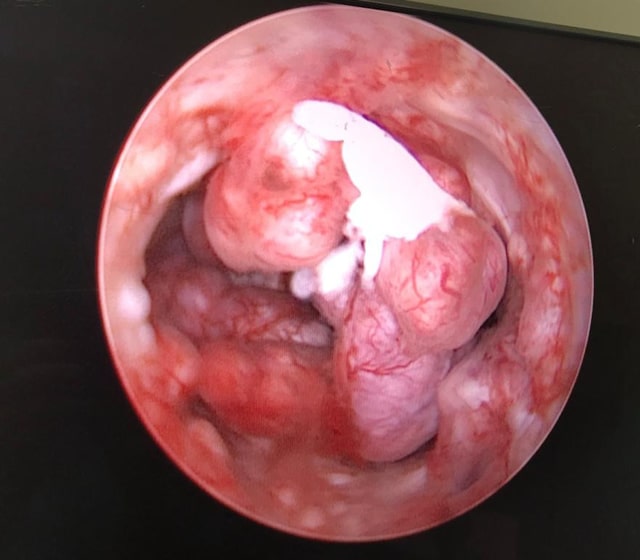 Latest Technology in Hysteroscopy