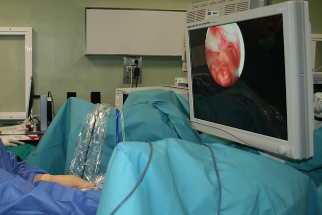 Hysteroscopic Surgery