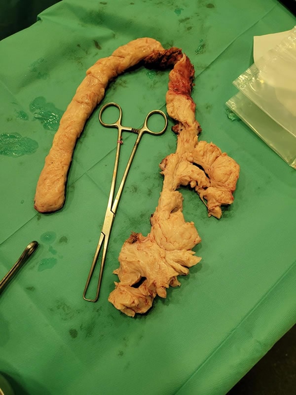 Uterine fibroid 14 cm in size