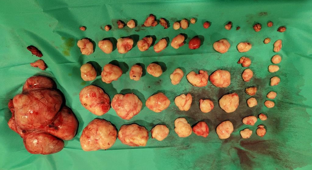 Extraction of 61 uterine fibroids