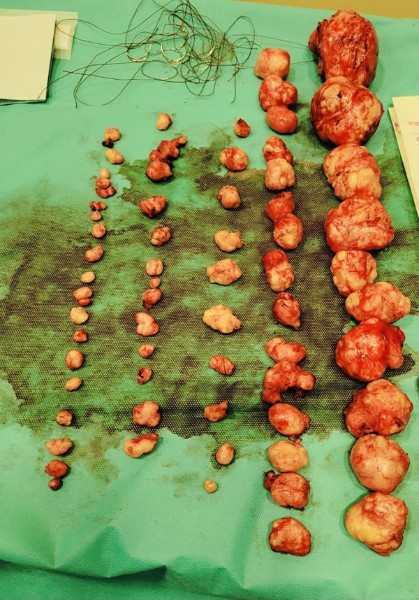Removal of 74 uterine fibroids without blood transfusion