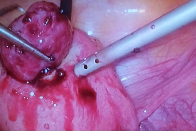 Laparoscopic Fibroid Removal