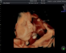 Ultrasound 5D