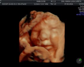 Ultrasound 5D