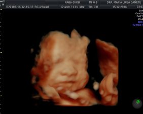 Ultrasound 5D