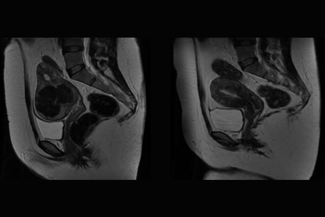 Gynecological 3D Doppler Ultrasound